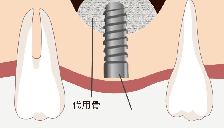 上顎洞底挙上術