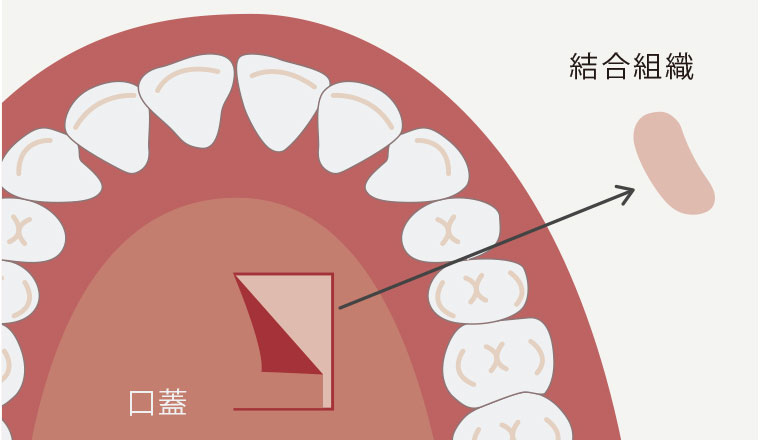 粘膜移植